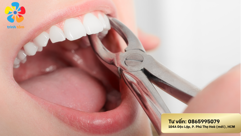 lợi trùm răng khôn