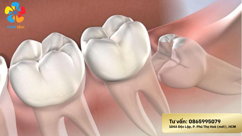 Răng khôn mọc lệch là gì | Nhổ răng khôn giá rẻ
