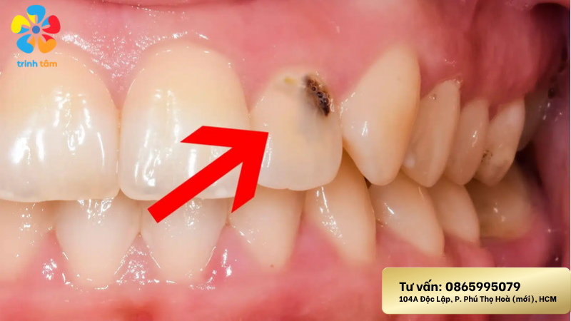 Sâu răng cửa điều trị như thế nào? | Trám răng giá rẻ