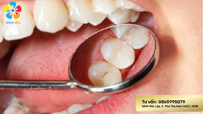 Trám răng có bị đổi màu không