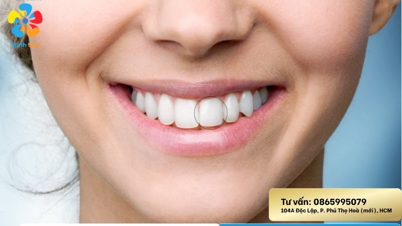 trám sâu răng cửa