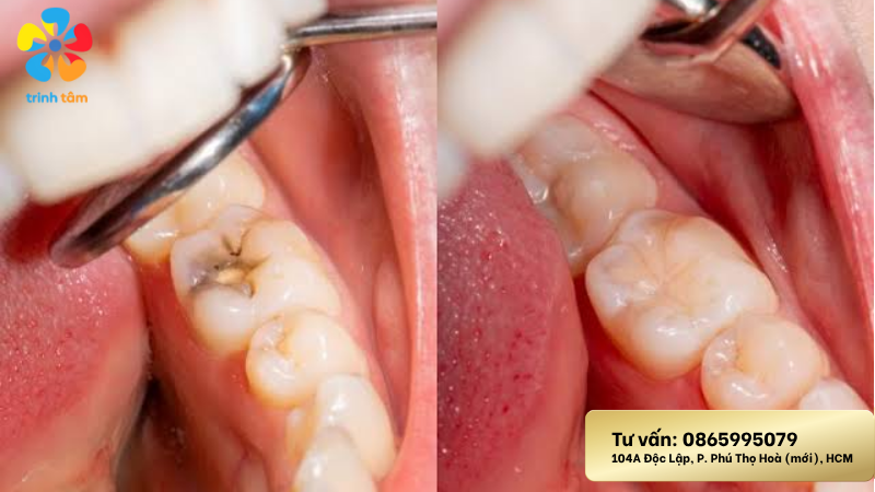 Trám răng đổi màu không | Trám răng Uy Tín Tân Phú